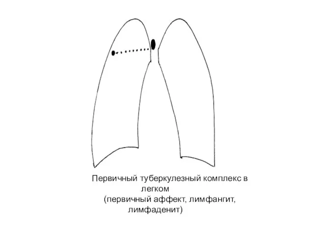 Первичный туберкулезный комплекс в легком (первичный аффект, лимфангит, лимфаденит)