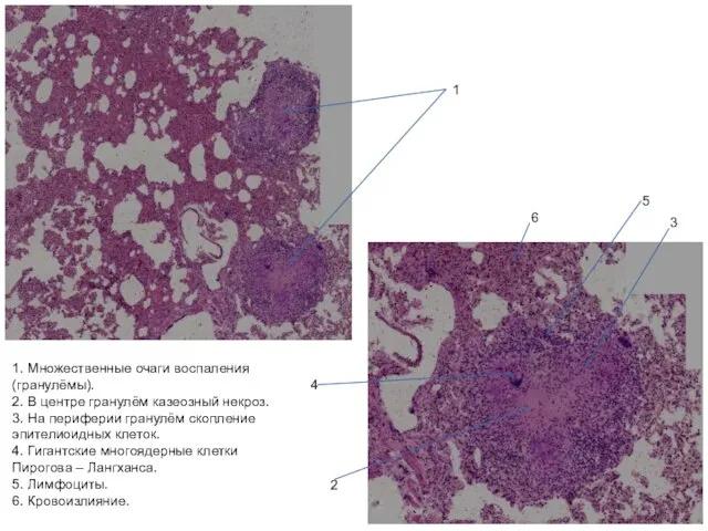 1. Множественные очаги воспаления (гранулёмы). 2. В центре гранулём казеозный некроз.