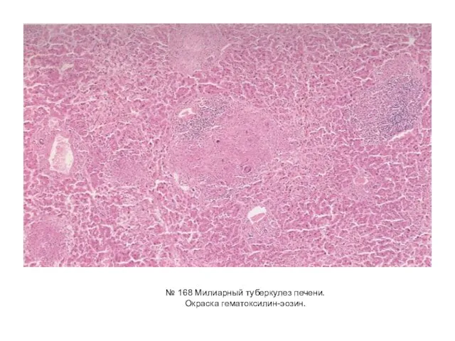 № 168 Милиарный туберкулез печени. Окраска гематоксилин-эозин.