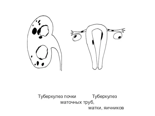 Туберкулез почки Туберкулез маточных труб, матки, яичников