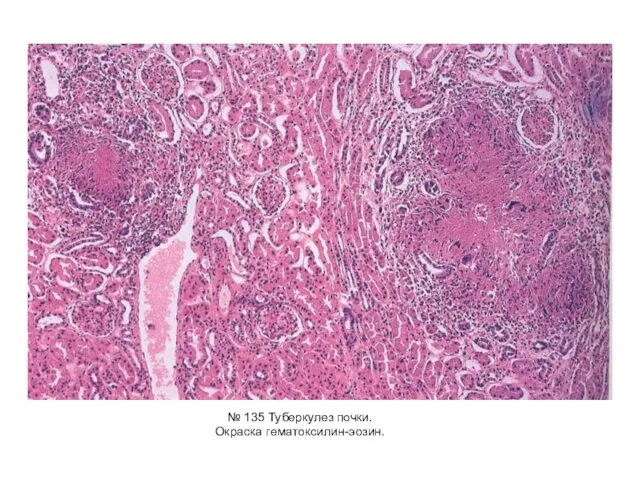 № 135 Туберкулез почки. Окраска гематоксилин-эозин.