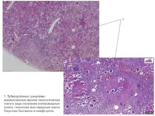 1. Туберкулёзные гранулёмы - множественные мелкие патологические очаги в виде скопления