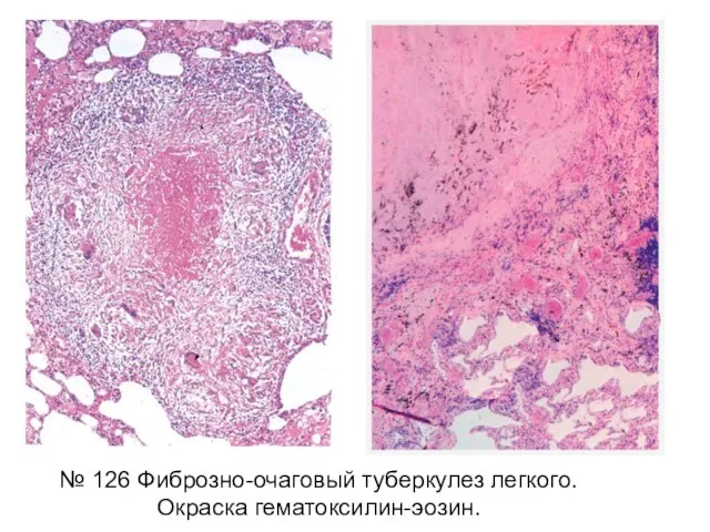 № 126 Фиброзно-очаговый туберкулез легкого. Окраска гематоксилин-эозин.