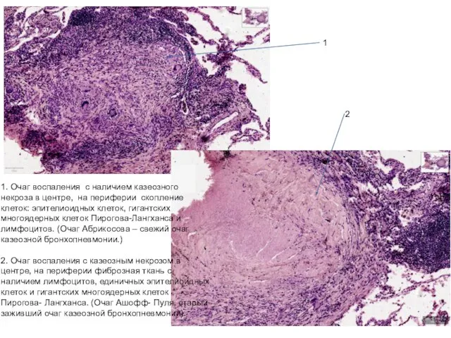 1. Очаг воспаления с наличием казеозного некроза в центре, на периферии