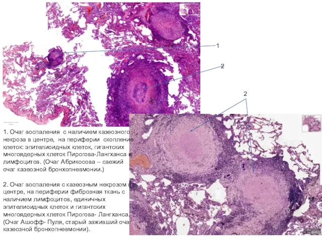 1. Очаг воспаления с наличием казеозного некроза в центре, на периферии