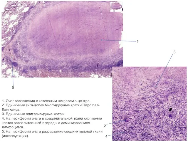 1. Очаг воспаления с казеозным некрозом в центре. 2. Единичные гигантские