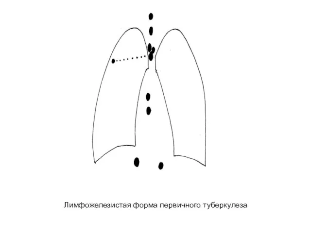 Лимфожелезистая форма первичного туберкулеза