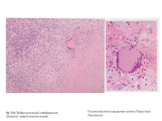 № 164 Туберкулезный лимфаденит. Окраска гематоксилин-эозин. Гигантская многоядерная клетка Пирогова-Лангханса