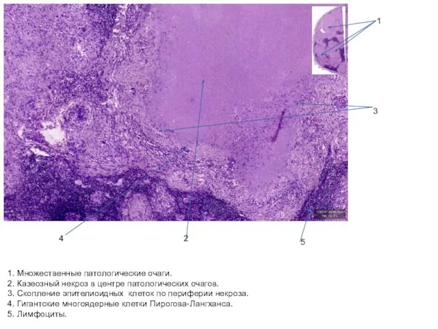 1. Множественные патологические очаги. 2. Казеозный некроз в центре патологических очагов.