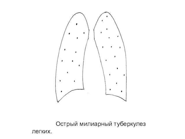 Острый милиарный туберкулез легких.