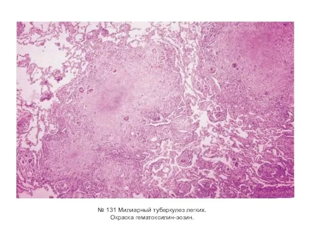 № 131 Милиарный туберкулез легких. Окраска гематоксилин-эозин.