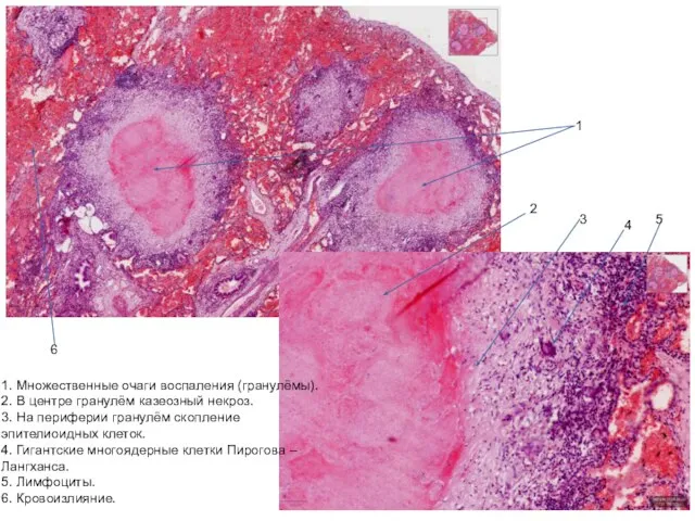 1. Множественные очаги воспаления (гранулёмы). 2. В центре гранулём казеозный некроз.