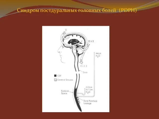 Синдром постдуральных головных болей (PDPH)