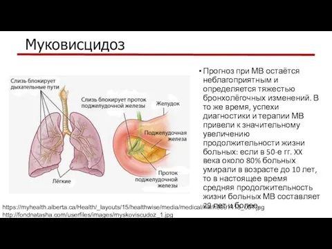 Муковисцидоз Прогноз при МВ остаётся неблагоприятным и определяется тяжестью бронхолёгочных изменений.