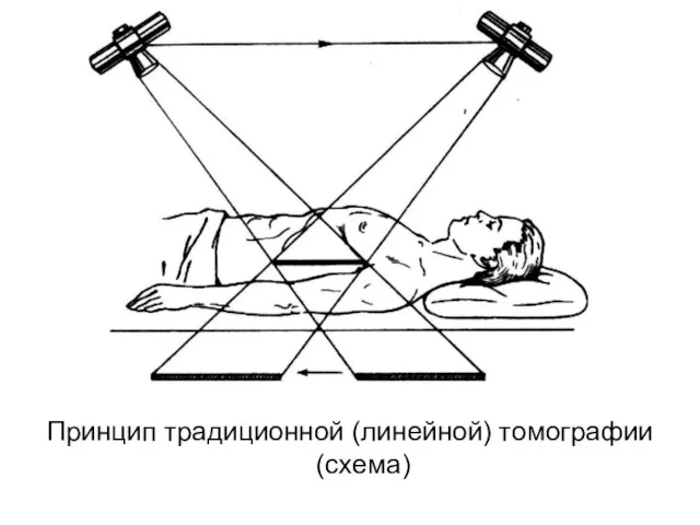 Принцип традиционной (линейной) томографии (схема)