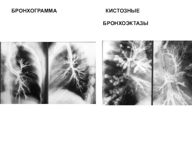 БРОНХОГРАММА КИСТОЗНЫЕ БРОНХОЭКТАЗЫ