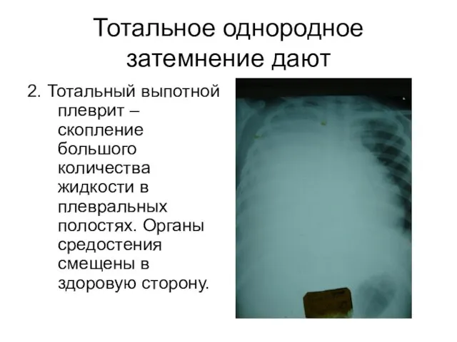 Тотальное однородное затемнение дают 2. Тотальный выпотной плеврит – скопление большого