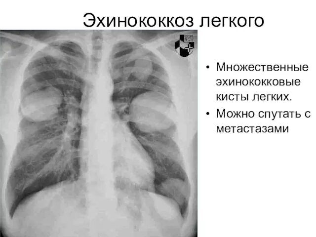 Эхинококкоз легкого Множественные эхинококковые кисты легких. Можно спутать с метастазами