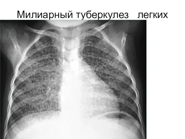 Милиарный туберкулез легких