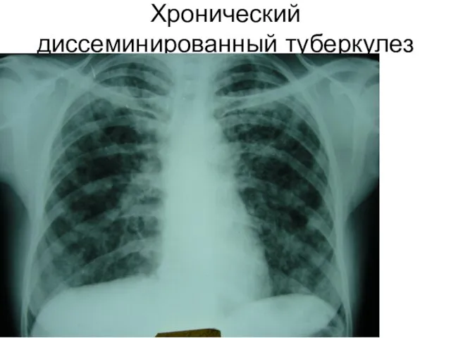 Хронический диссеминированный туберкулез