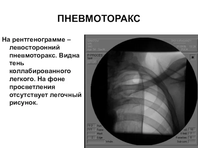 ПНЕВМОТОРАКС На рентгенограмме – левосторонний пневмоторакс. Видна тень коллабированного легкого. На фоне просветления отсутствует легочный рисунок.