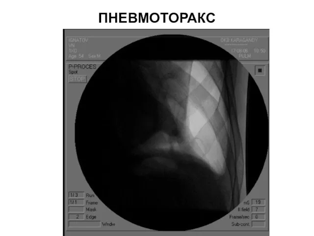 ПНЕВМОТОРАКС