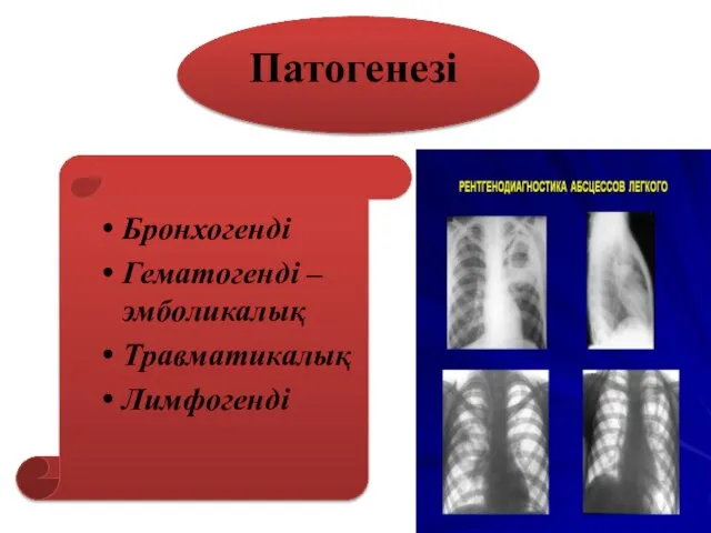 Патогенезі Бронхогенді Гематогенді – эмболикалық Травматикалық Лимфогенді