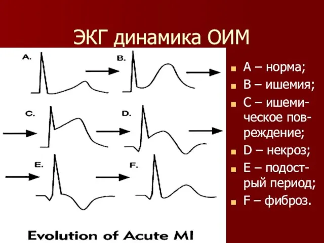 ЭКГ динамика ОИМ А – норма; В – ишемия; С –