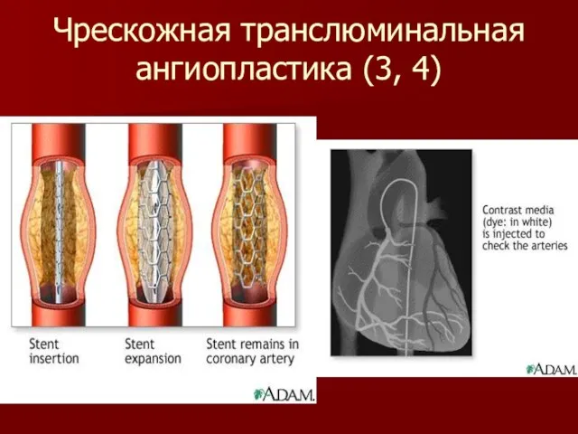 Чрескожная транслюминальная ангиопластика (3, 4)