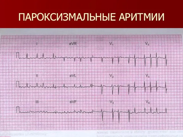 ПАРОКСИЗМАЛЬНЫЕ АРИТМИИ