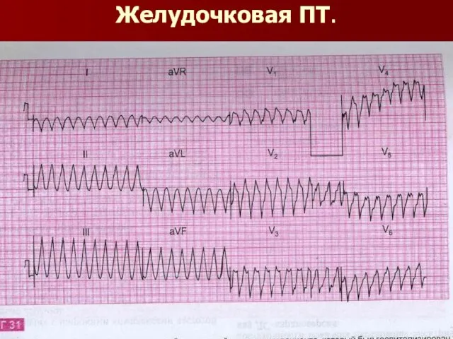 Желудочковая ПТ.