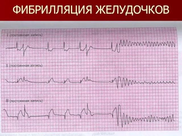 ФИБРИЛЛЯЦИЯ ЖЕЛУДОЧКОВ