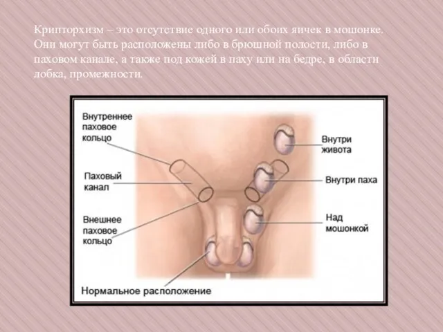 Крипторхизм – это отсутствие одного или обоих яичек в мошонке. Они
