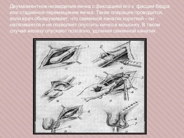 Двухмоментное низведение яичка с фиксацией его к фасции бедра или стадийное