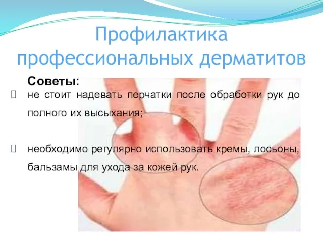 Профилактика профессиональных дерматитов Советы: не стоит надевать перчатки после обработки рук