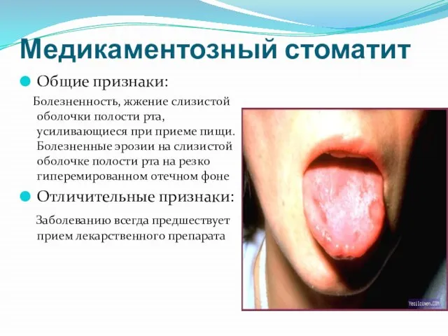 Медикаментозный стоматит Общие признаки: Болезненность, жжение слизистой оболочки полости рта, усиливающиеся