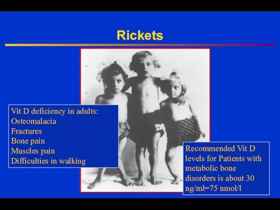 Rickets Vit D deficiency in adults: Osteomalacia Fractures Bone pain Muscles