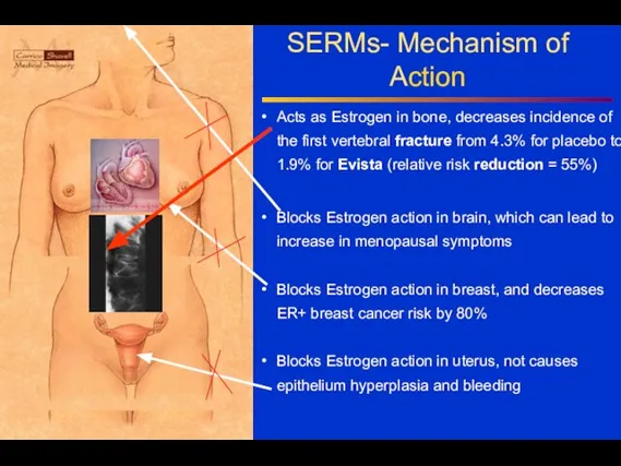 SERMs- Mechanism of Action Acts as Estrogen in bone, decreases incidence