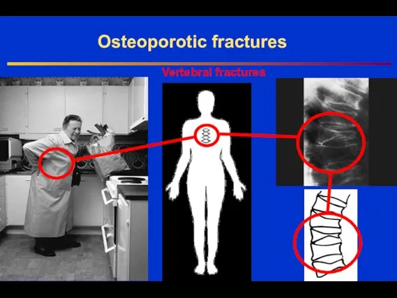 Vertebral fractures Osteoporotic fractures