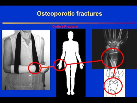 Osteoporotic fractures Colle’s Fracture