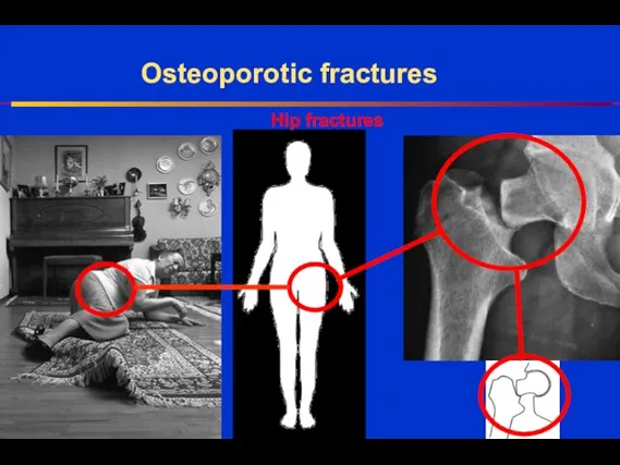 Hip fractures Osteoporotic fractures