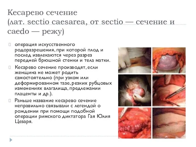 Кесарево сечение (лат. sectio caesarea, от sectio — сечение и caedo