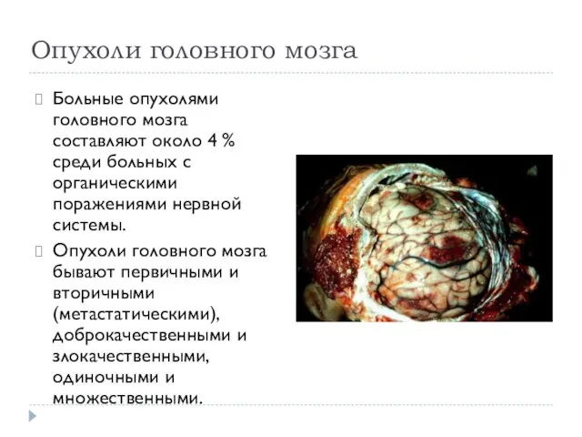 Опухоли головного мозга Больные опухолями головного мозга составляют около 4 %