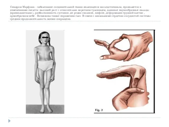 Синдром Марфана - заболевание соединительной ткани являющееся наследственным, проявляется в изменениими