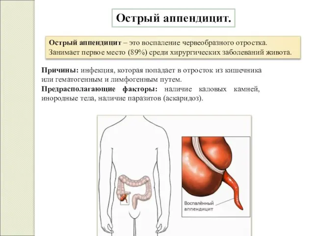 Острый аппендицит. Острый аппендицит – это воспаление червеобразного отростка. Занимает первое