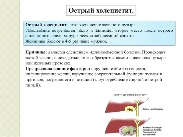 Острый холецистит. Острый холецистит – это воспаление желчного пузыря. Заболевание встречается