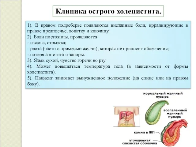 Клиника острого холецистита. 1). В правом подреберье появляются внезапные боли, иррадиирующие