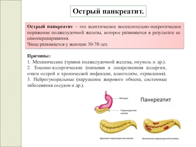 Острый панкреатит. Острый панкреатит – это асептическое воспалительно-некротическое поражение поджелудочной железы,