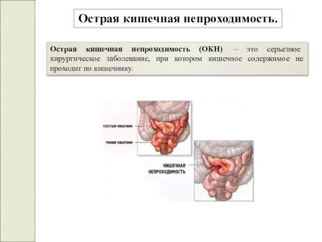 Острая кишечная непроходимость. Острая кишечная непроходимость (ОКН) – это серьезное хирургическое