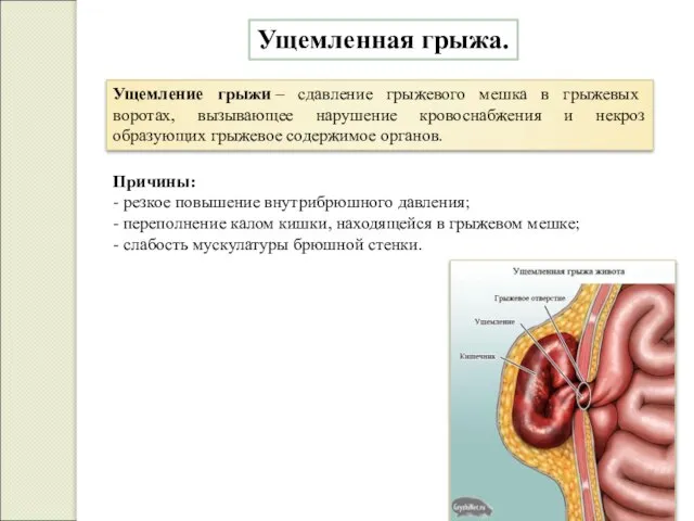 Ущемленная грыжа. Ущемление грыжи – сдавление грыжевого мешка в грыжевых воротах,